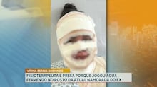 Menina de 7 anos leva pontos no rosto após cair de patinete ao fugir de cachorro em Contagem